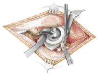 Pohled operatéra při implantaci umělé kyčle