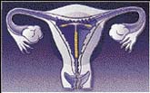 Jedním z antikoncepčních prostředků pro ženy je nitroděložní tělísko umístěné v děloze