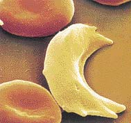 nemocná krvinka s mutovaným hemoglobinem