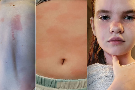 Dívka (12) trpí extrémně vzácnou alergii na vodu: Sprchování by ji mohlo zabít!