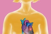 Mýty a pravdy o srdeční arytmii: Může to potkat i vás!