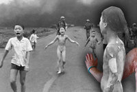 Ikonické foto z války ve Vietnamu: Žena po 40 letech podstoupí léčbu jizev