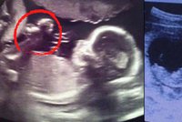 Démon i anděl v děloze! Neuvěřitelné ultrazvuky nenarozených dětí