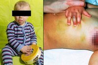 Teprve rok a půl starého chlapečka týrali rodiče: Měl popálené nohy a obličej samou modřinu