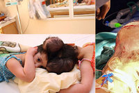 Úspěch lékařů: Za 10 hodin rozdělili siamská dvojčata srostlá hlavami