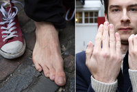 Muž se narodil s nefunkční rukou: Lékaři mu na ni přišili prsty z nohou!