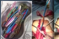 Nechutné video: Muž měl v žaludku na 20 zubních kartáčků, chirurgové je tahali jeden po druhém