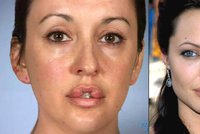 Chtěla mít rty jako Angelina Jolie: Už 10 let nemůže zavřít ústa
