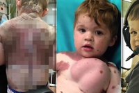 Chlapeček se narodil s děsivým znaménkem: Život mu zachránily prsní implantáty!