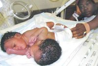 Týdenní siamská dvojčata: Zemřela těsně před oddělením