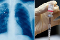 Světu hrozí epidemie tuberkulózy. Léky na ni přestávají fungovat