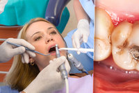 Zubaři mají náhradu za zakázané plomby. Amalgám letos skončí