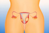 Děložní myomy ohrožují až 40 % žen: Nová léčba se obejde bez operace!