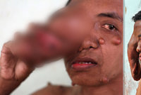 Muž (34) z Indonésie bojuje s gigantickým nádorem: Podstoupil už několik operací, vždycky doroste!