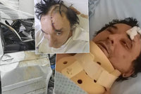 Frontman kapely Plexis o děsivé nehodě: Skalpovaná půlka hlavy, krok od smrti!