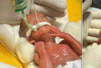 Kristýnka při porodu vážila pouhých 322 gramů. Život jí zázračně zachránili lékaři v Podolí