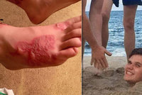 Michaela (17) na pláži zakopali do písku: Do nohy se mu nastěhovali červi