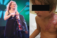 Popálený syn houslistky Muzikářové po transplantaci kůže: Ochranná trička a neustálé masírování jizev