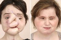 Před třemi roky se střelila do obličeje. Lékaři dali Katie (21) „novou tvář“