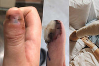 Dívka (20) si kousáním nehtů způsobila rakovinu! Lékaři jí museli amputovat kus ruky