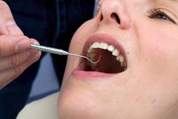 Změna u zubaře: Amalgám „na pojišťovnu“ bude jen v kapslích, pro děti a těhotné vůbec