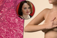 Rakovinu prsu můžete dostat i ze stresu, varuje lékařka. Jaká je šance na vyléčení?