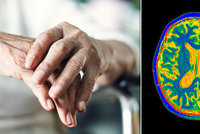 Alzheimerem trpí stále mladší lidé. Boty jim končí v troubě a mobil v lednici