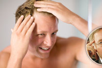 Počítáte s hrůzou každý vlas? 5 mýtů o plešatosti podle dermatologa