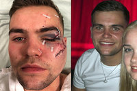 Mladík skončil v krvi. Agresor mu rozbil půllitr o obličej: Jedinou ranou mu takřka odřízl tvář!