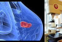 Nový mamograf v Brně: Rakovina v prsu svítí červeně