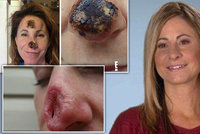 Homeopatika ženě »rozpustily« nos! Lékaři jí museli udělat úplně nový