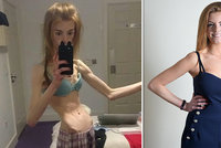 Bloggerka (21) vážila pouhých 28,5 kg! Vyhrát nad anorexii jí pomohly čokoládové bonbony