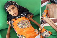 Tohle je tvář války: Fatima (12) váží sotva 10 kilo, s rodinou žije pod stromem