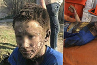 Chlapci (14) zčernala tvář poté, co ho zasáhlo 10 tisíc voltů. Popáleniny má na 40 % těla