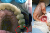 Kulervoucí objev: Chlapci (13) chyběl zub, lékaři ho našli ve varleti