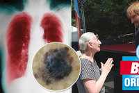 Konečný účet Blesk Ordinace: 57 nádorů kůže, 61 plicních nemocí! Lidé vzali prevenci vážně