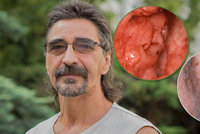 Rakovina vzala Zdeňkovi čelist, lícní kost, kus jazyka: Přežil a lékaři mu vrátili tvář!