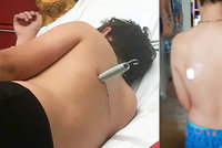 Trampolína poranila dítě (12): Uvolněná pružina mu prostřelila záda!