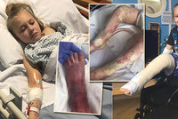 Školačka (11) přišla o obě nohy kvůli děsivé infekci! Neměla potřebné očkování