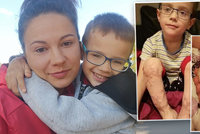 Jakub (4) přišel o prsty na nohou i rukou: Maminka shání peníze na operaci, která mu má pomoci chodit