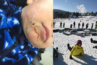 Syna mu zranila uvolněná lyžařská branka: Namísto pomoci mu lidé ještě vynadali!