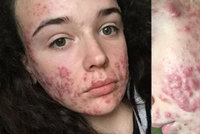 Dívka popsala život s brutálním akné: Polštář od krve, bolesti a posměšky!