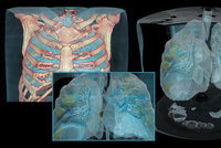 Šokující model lékařů: Takhle vypadají plíce poškozené koronavirem