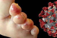 Varování pro rodiče: „Covidové prsty“ můžou být u dětí jediným příznakem koronaviru