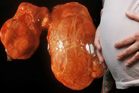 Porucha štítné žlázy může způsobit potrat. Lékaři vyzývají budoucí matky k vyšetření