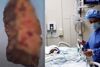 Koronavirus „rozežral“ dívce plíce. Musela podstoupit oboustrannou transplantaci