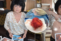 Jarmila (75) měla umělá prsa 40 let, teď je rozežrala bakterie! Boj o život i odškodné!