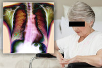 Lucie (84) myslela, že má jen chřipku! Rakovinu plic porazila díky imunologické léčbě