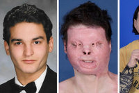 Šance na nový život: Znetvořenému muži po nehodě poprvé transplantovali obličej i ruce