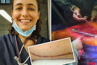 Studentce medicíny odhalili pražští lékaři nádor: Kvůli rakovině jí sebrali stehenní kost:
